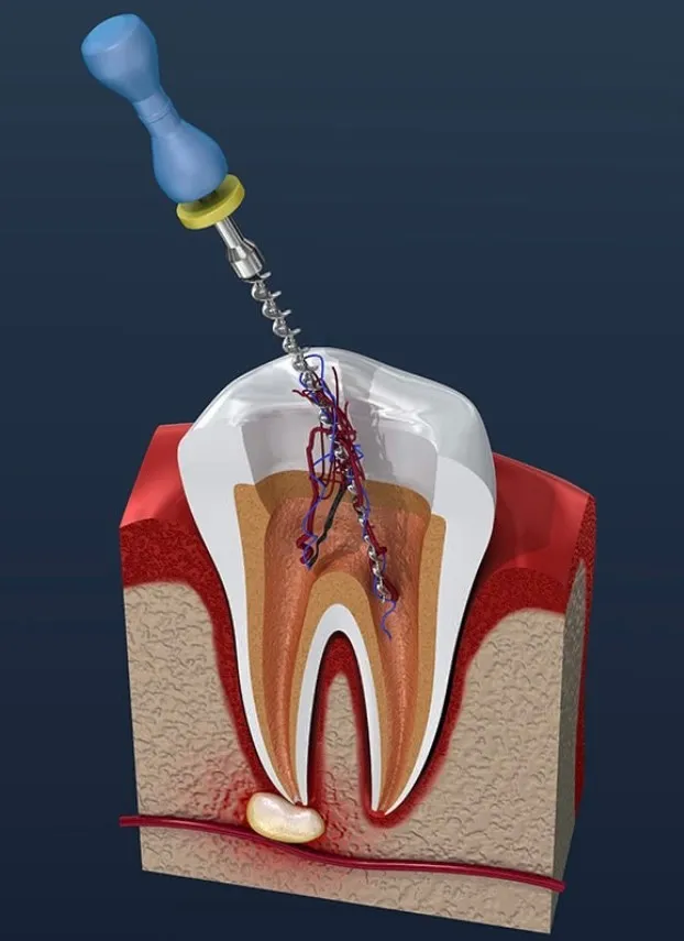 root canal treatment near me