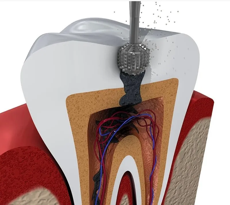 root canal treatment pain