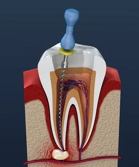 Root canal specialist